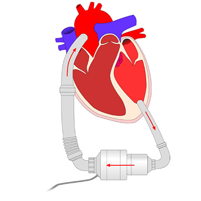 Left Ventricular Heart Assist Device (LVAD)